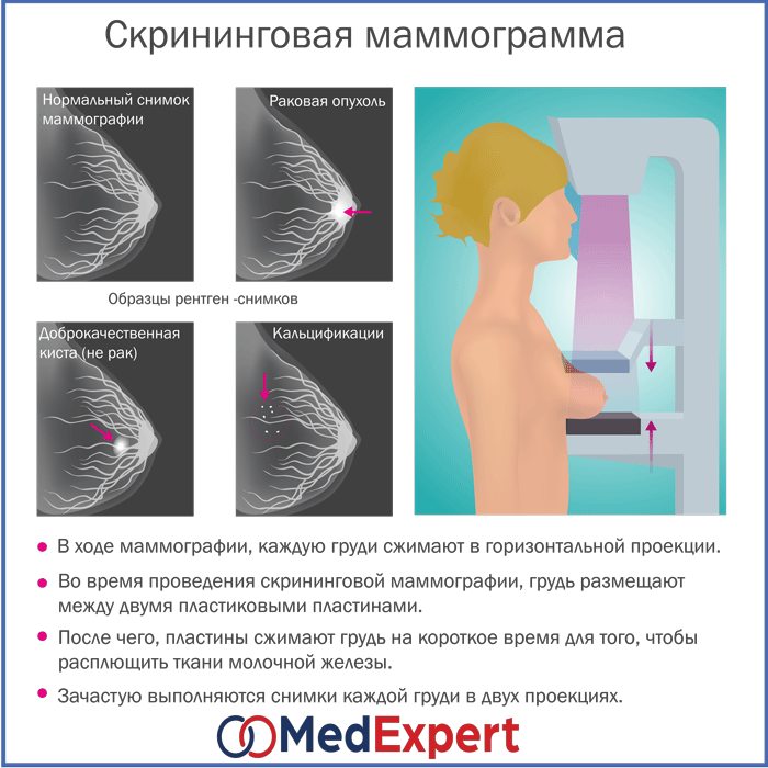 Киста в молочной железе: диагностика и лечение в клинике Hadassah